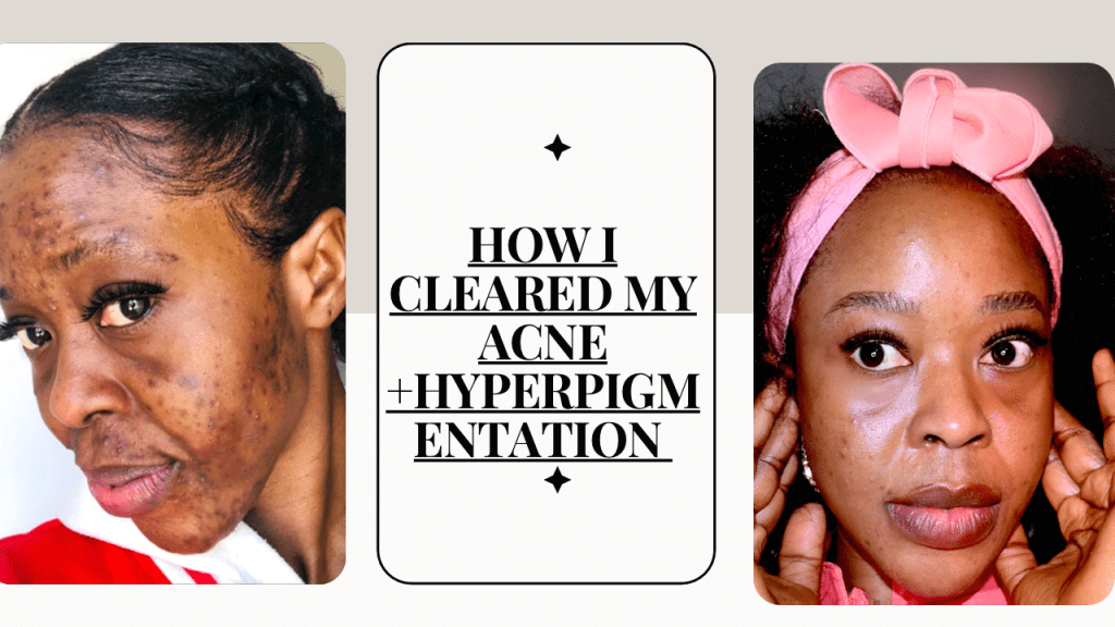 How I Got Rid of My Facial Acne And Hyperpigmentation